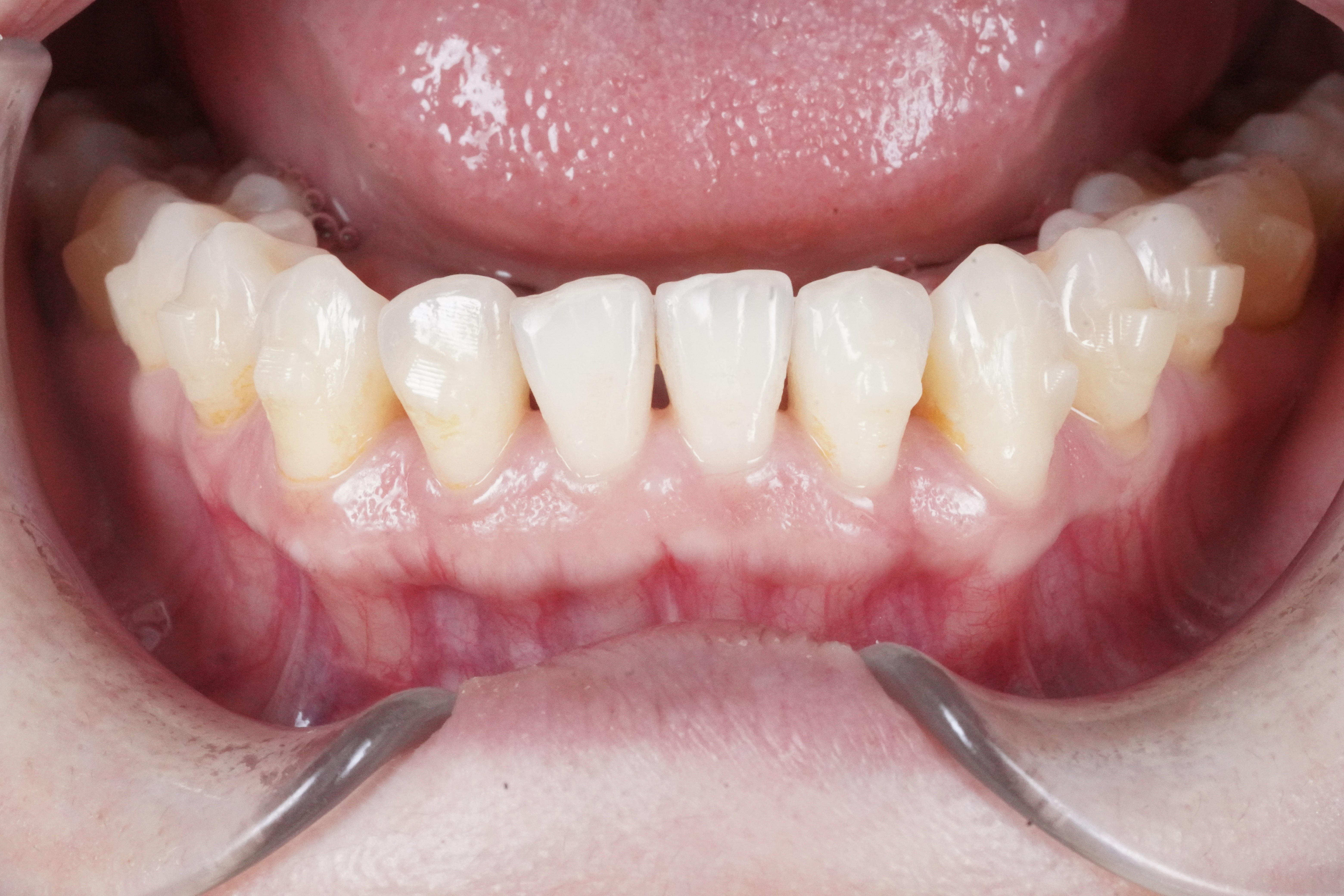 Before treatment